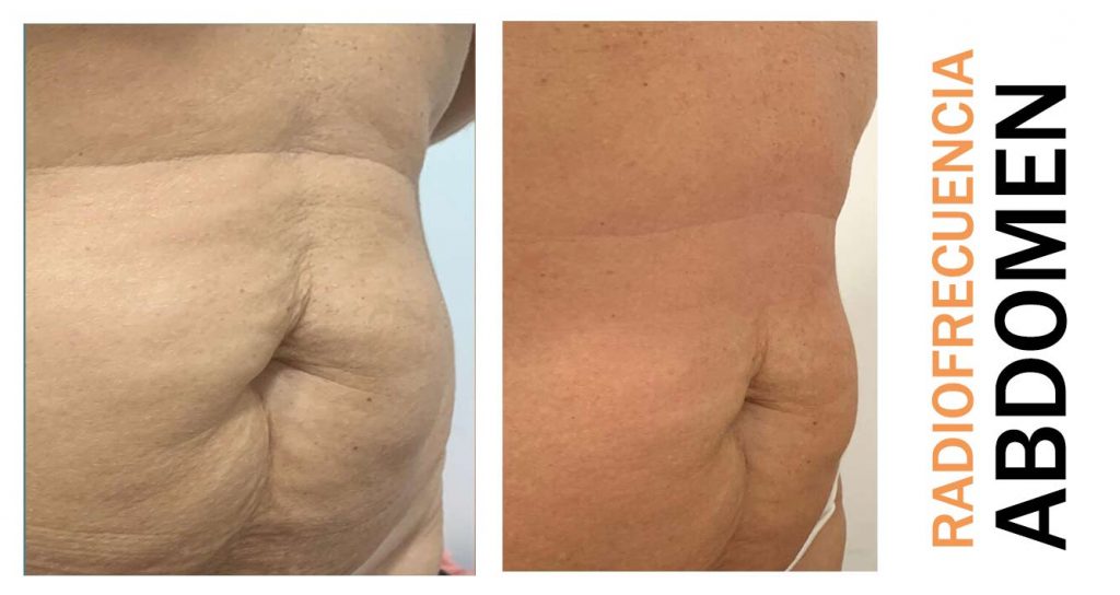 radiofrecuencia-abdomen barriga symmed-sabadell